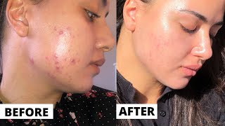 Tretinoin 3 month Update FAITH RESTORED  Tretinoin Before And After Results  DERMATICA [upl. by Ddat]