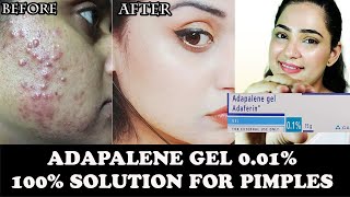 Adapalene Gel 01 Review  How much effective it is for Acne amp Pimples  adaferin gel 01 review [upl. by Duyne]