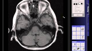 BRAIN MRI OLD INFARCTION [upl. by Yltnerb]