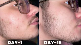 Day1 to day15 minoxidil beard growth results  minoxidil beard growth  derma roller for beard [upl. by Ada]