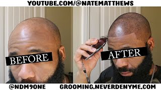 How To Get Your Hairline Back  From Bald To Edge Up  Hairline Restoration [upl. by Kippy]