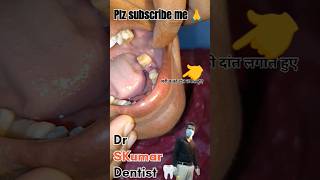 Ceramic crown fitting DentalXYZ trending viralshorts reels plesesubscribe 🙏🙏🦷 [upl. by Mushro]