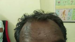 Hair loss Graying of hair Baldness Acne Allergy treatment [upl. by Booma]