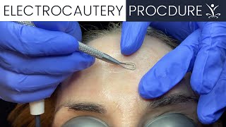 Watch an Electrocautery Procedure [upl. by Attalanta168]