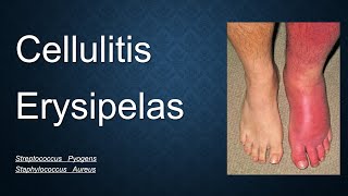 Cellulitis Erysipelas lecture penicillin V drug skin infection USMLE medical Roze pharm [upl. by Akirdnwahs]