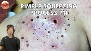 The MOST TERRIFYING Acne Squeezing Videos Youve Ever Seen 11 [upl. by Abbotsun]