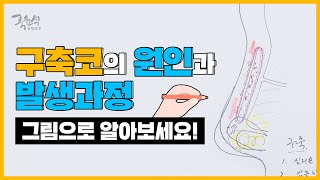 구축코의 원인과 발생과정 Causes and Developing process of Contracted Nose [upl. by Nealon]