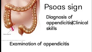 Psoas signExamination of appendicitisDiagnosis of appendicitisClinical skills appendicitis [upl. by Cohligan]