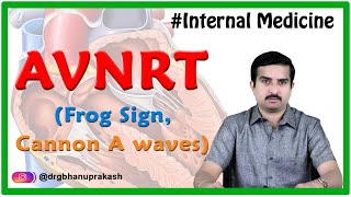 Atrioventricular nodal reentrant tachycardia AVNRT  Internal medicine National USMLE Step 2 ck [upl. by Ardra]