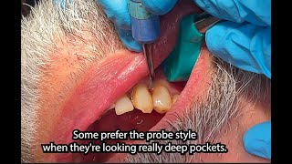 Ultrasonic probe vs curette technique When to use each one [upl. by Filiano]