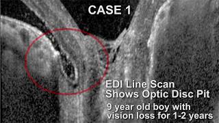 Inner Retinal Fenestration for Optic Nerve Pit Maculopathy [upl. by Now638]