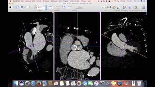 TAVR Planning Using Osirix [upl. by Ahseal]