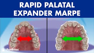 Rapid PALATAL expander MARPE  This ORTHODONTIC device can EXPAND the PALATE in adults© [upl. by Cohe161]