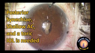 Cataract Surgery with Lysis of Posterior Synechiae and Pupil Restoration [upl. by Nomyad]