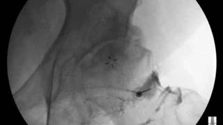 Hip Injection under Fluoroscopic Guidance  ThePainSourcecom [upl. by Nosremaj]