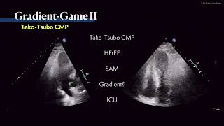 〖Echocardiography〗 Where is the gradient 💘 💫 [upl. by Enirok]