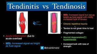 Tendinitis VS Tendinosis  Simplified [upl. by Esiole]