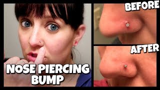 How To Get Rid Of A Nose Piercing Bump FAST  Keloid 📍 How To With Kristin [upl. by Yerhpmuh272]