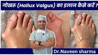 hallux valgus TREATMENT AT HOME [upl. by Suanne]