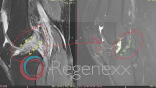 Regenexx ACL Procedure  PercACLR Before and After Compilation [upl. by Sevein]