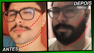 EVOLUÇÃO MINOXIDIL 1 ANO E 4 MESES Pant Foligain e Kirkland [upl. by Wehttan]