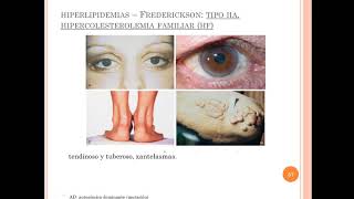 Dislipidemias primarias DX y tratamiento [upl. by Ymma291]