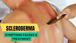 Scleroderma Symptoms Causes amp Treatment [upl. by Enrev]