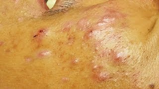 Enlever les points noirs les microkystes et un acné kystique a cystic acne [upl. by Atilol]