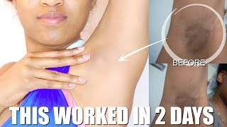 HOW TO LIGHTEN MY DARK UNDERARMS FAST ALL NATURAL DIY [upl. by Mixie69]