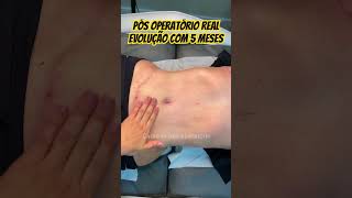 Cadrena pós Abdominoplastia x lipoescultura HD posoperatorio atendimentohumanizado brasil corpo [upl. by Nywroc]