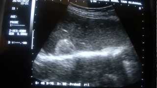 ULTRASOUND LIVER HEMANGIOMAS [upl. by Danais]