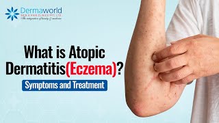 What is Atopic DermatitisEczema  Symptoms and Treatment  DermaworldDelhi DrRohitBatra [upl. by Three]