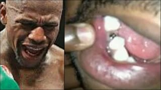 MAYWEATHER GETS TOOTH KNOCKED OUT NOSE BROKE HAND BROKE SLIPPING THE MAYWEATHER STANDARD [upl. by Conah542]