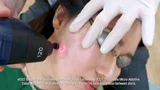 Co2 Fractional Laser Treatment [upl. by Ahsied480]