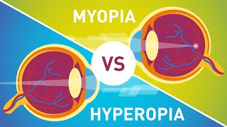 Difference between Myopia Near Sightedness amp Hyperopia FarSightedness [upl. by Hahnke]