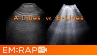 Ultrasound of Pulmonary Edema [upl. by Adiari452]