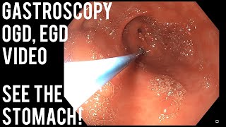 Gastroscopy  OGD  See inside the stomach [upl. by Enived]