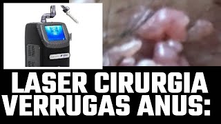 Fazendo cirurgia Laser verrugas hpv na pele perianal c anestesia local e alta a seguir há 38 anos [upl. by Germann]