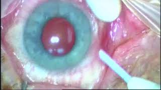 Intravitreal Ozurdex Implant [upl. by Nuahsar365]