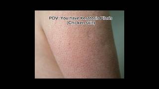 POVYou have keratosis Pilarischicken skinshortskeratosispilarischickenskinstrawberryskin [upl. by Ycats]