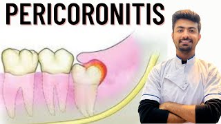 Pericoronitis Causes  Treatment [upl. by Ettenej]