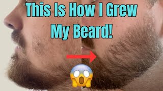 This Is How I Grew My Beard With Minoxidil And a Derma Stamp [upl. by Llemor665]