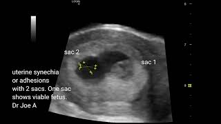 Uterine synechia or adhesions in early 7 weeks pregnancy two gestation sacs ultrasound video [upl. by Yetah]