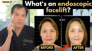 Whats an Endoscopic Facelift Wave Plastic Surgery [upl. by Llirrehs841]