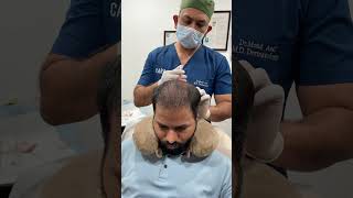 1st PRP Session After Hair Transplant [upl. by Dwain]