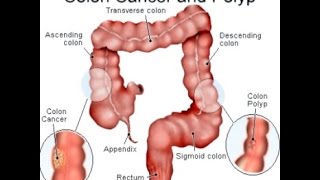 Colon Cancer [upl. by Nnyleuqaj711]