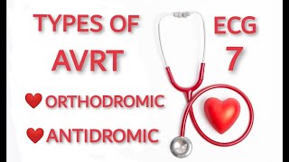 AVRT TYPES ORTHODROMIC AND ANTIDROMIC [upl. by Shreeves628]