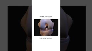 Arthrex acl surgery medical medicalstudent [upl. by Ertsevlis]