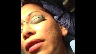 Acne Scarring Treated with Mixto CO2 laser Dr David Rahimi Forever Young Inc [upl. by Imot]