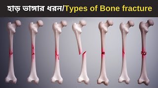 Common types of Bone fracture  3D animation  Bangla [upl. by Nywra]